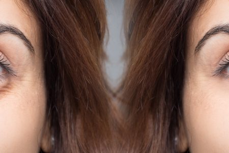 fillers onder de ogen