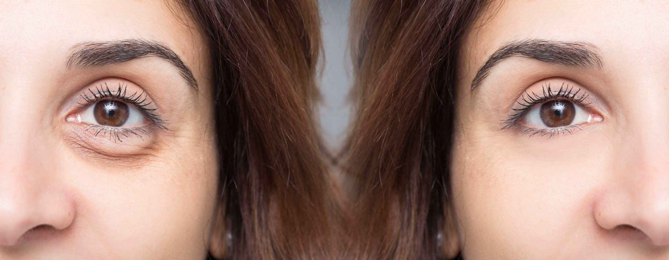 Wat je moet weten over fillers onder de ogen
