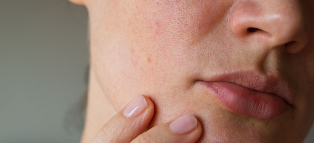 rosacea huid